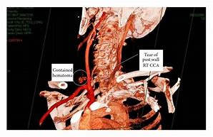 Image result for Carotid Artery Pain Left Side
