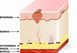 Image result for Squamous Cell Carcinoma Skin Staging