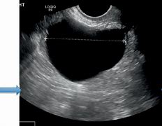 Image result for Follicular Cyst Ultrasound