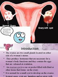 Image result for 10 Cm Cyst On Ovary