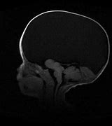 Image result for Hydranencephaly Ultrasound Images