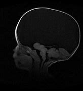 Image result for Hydranencephaly MRI Radiopaedia