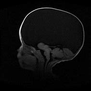 Image result for Anencephaly Radiology