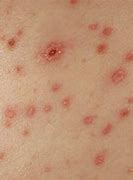 Image result for Acetaminophen Allergy Rash