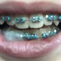 Image result for Teal Braces for Teeh