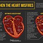 Image result for What Causes Atrial Fibrillation