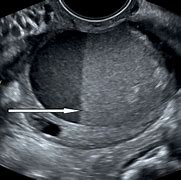 Image result for Ovarian Cyst with Debris