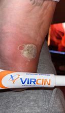 Image result for Vircin Advanced Wart Treatment