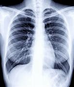 Image result for A Healthy Lung