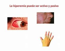 Image result for hiperemia