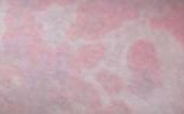 Image result for Allergy Rash Legs