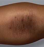 Image result for Eczema On Dark Skin