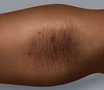 Image result for Eczema Brown Skin