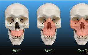 Image result for Types of Jaw Fractures
