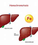 Image result for hemocromatosos