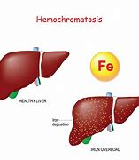 Image result for hem9cromatosis