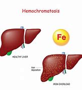 Image result for hemoc5omatosis