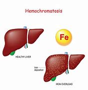 Image result for hemocrkmatosis