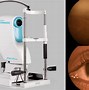 Image result for Posterior Chamber IOL