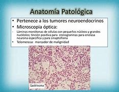 Image result for hiperclorhidria