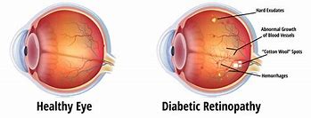 Image result for Retinal Changes Diabetes