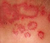 Image result for Food Allergy Symptoms Skin Rash