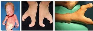 Image result for Ectrodactyly