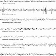 Image result for Normal EEG Tracing