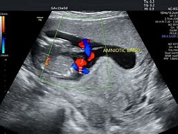 Image result for Amniotic Band Syndrome Ultrasound