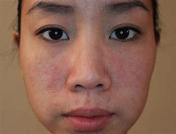 Image result for Gluten Allergy Rash On Face