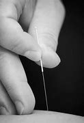 Image result for Medical Acupuncture