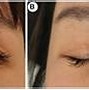 Image result for Double Eyelid Case