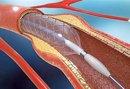 Image result for Angioplasty of the Carotid Artery