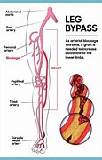 Image result for Arterial Bypass
