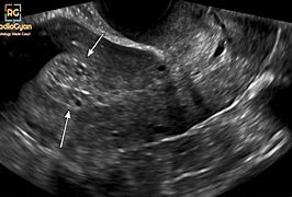 Image result for Endometrium Hyperplasia On Ultrasound Image