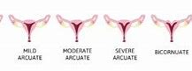 Image result for Arcuate Uterus