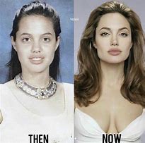 Image result for Angelina Jolie Lip Filler