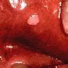 Image result for Genital Warts in Mouth