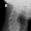 Image result for Congenital Cervical Spine Fusion