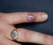 Image result for ORF Infection