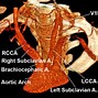 Image result for Internal Carotid Artery Pathway