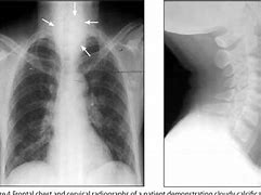 Image result for Thyroid Cartilage Calcification On X-ray