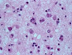Image result for Epidemic Encephalitis B