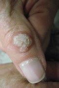 Image result for Flat Wart Treatment