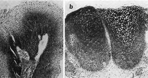 Image result for Exophytic Papilloma