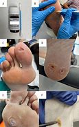 Image result for Wart Treatment with Salicylic Acid