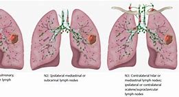 Image result for Hilar Nodule Lung