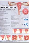 Image result for Cervical Cancer