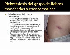 Image result for actinomocosis