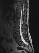 Image result for MRI for Lumbar Spine
